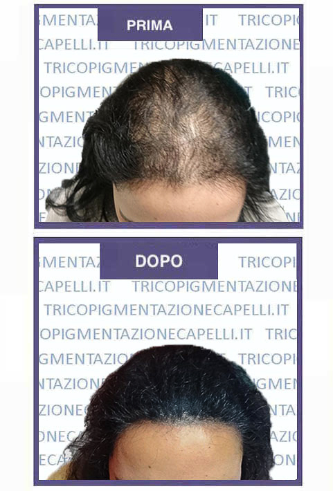 infoltimento capelli donne