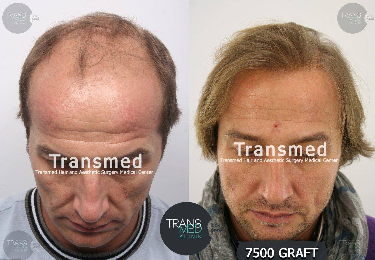 Foto 3 - Trapianto di capelli in Turchia: la soluzione definitiva low cost