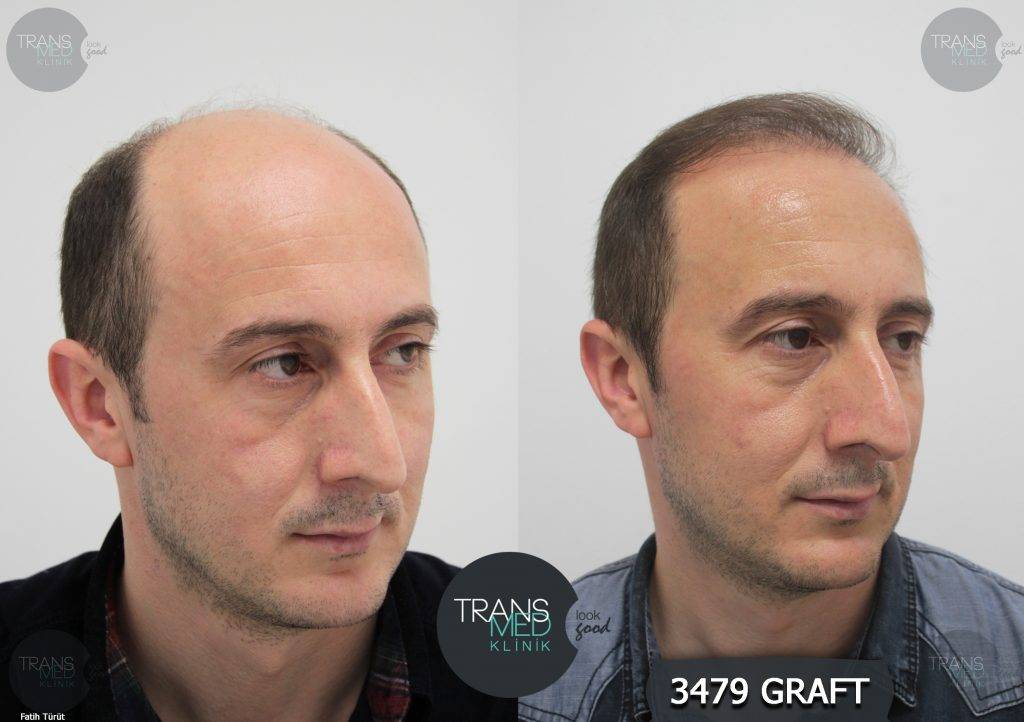 Foto 6 - Trapianto di capelli in Turchia: la soluzione definitiva low cost
