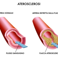 Chirurgia vascolare Lecce: l'arteriosclerosi, cos'è e come curarla