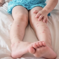 Bambini e zanzare: quale dopo puntura usare?