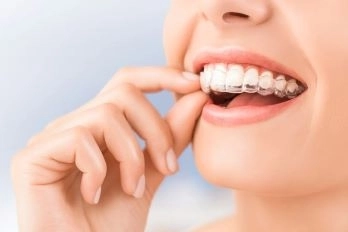 Ortodonzia invisibile Invisalign  Centro Odontoiatrico Ceccaioni a Frascati