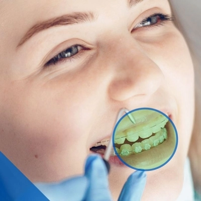 Ortodonzia Invisibile per allineare i tuoi denti senza il fastidio degli attacchi ortodontici