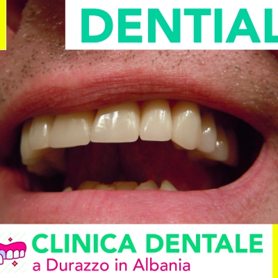 Corone e impianti dentali presso i dentisti in Albania