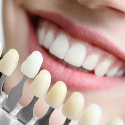 Esplorando i Colori dei Denti: Una Guida alla Salute Dentale