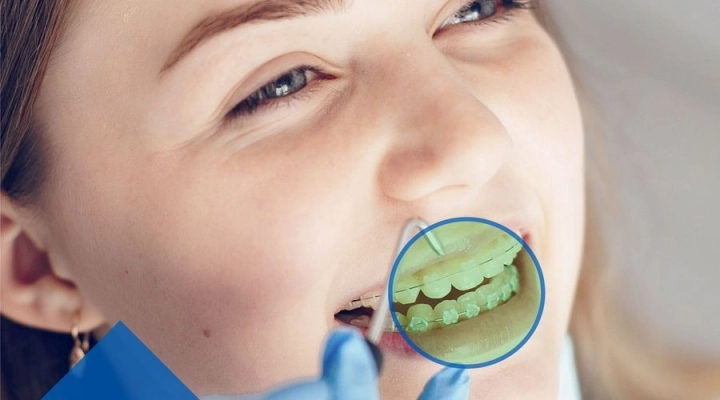 Ortodonzia Invisibile per allineare i tuoi denti senza il fastidio degli attacchi ortodontici